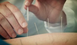 Acupuncture in Riverside, Your Holistic Acupuncture Clinic in Riverside